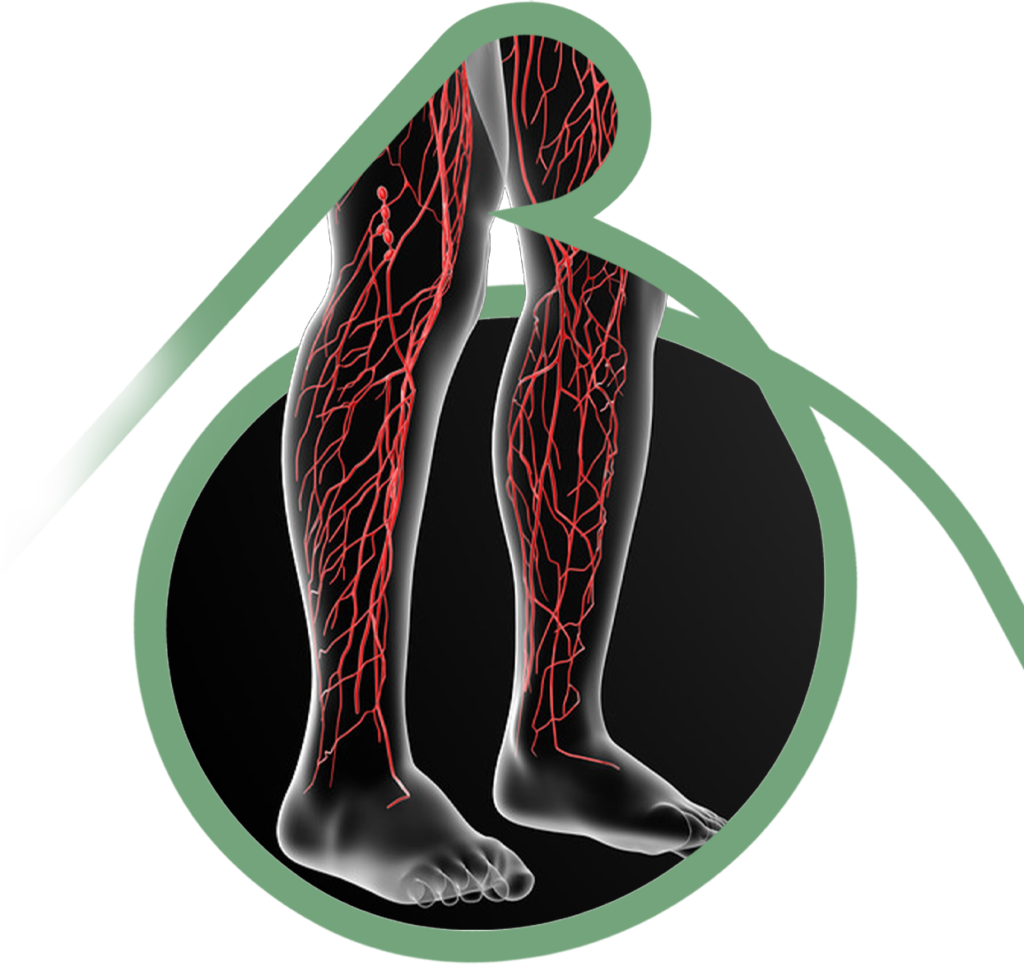 Varizes - Clínica Vascular em São Bernardo e Santo André
