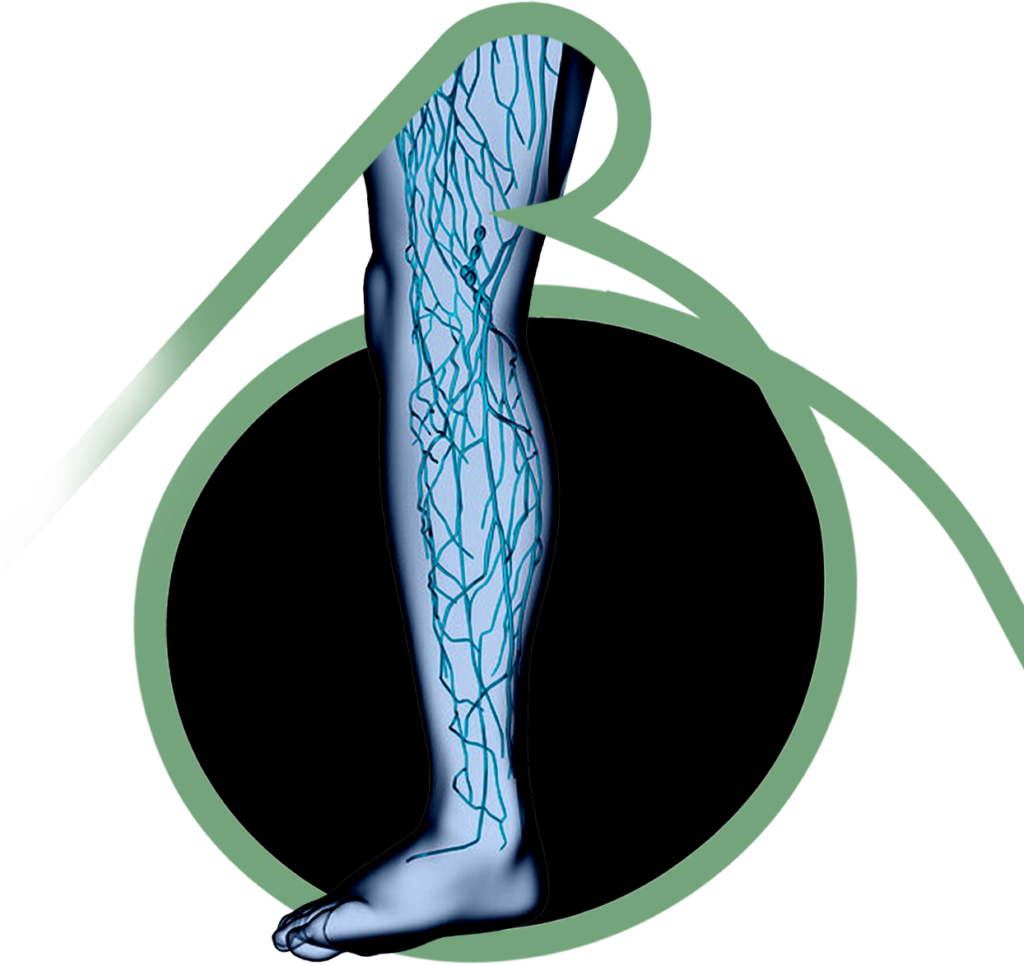 Varizes de Membros Inferiores- Clínica Vascular em São Bernardo e Santo André